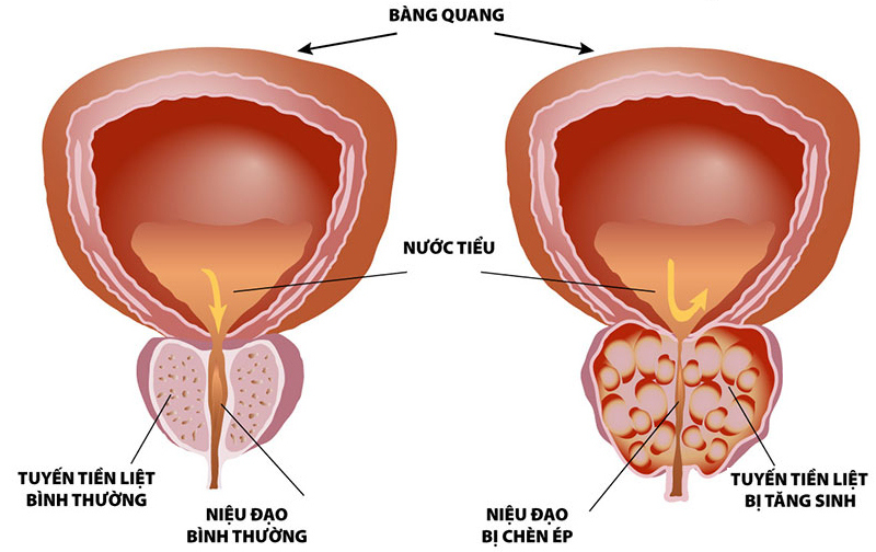  Hình ảnh tuyến tiền liệt bình thường và phì đại tuyến tiền liệt