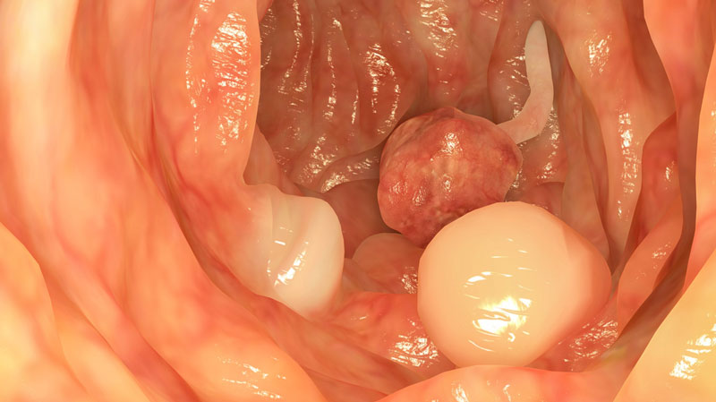 Polyp đại tràng có nguy hiểm không? Điều trị như thế nào?