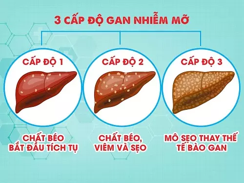 3 mức độ của gan nhiễm mỡ