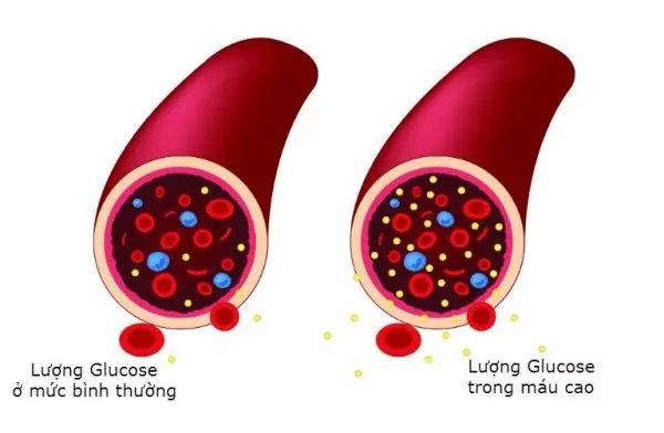 Đường huyết cao hoặc lên xuống thất thường