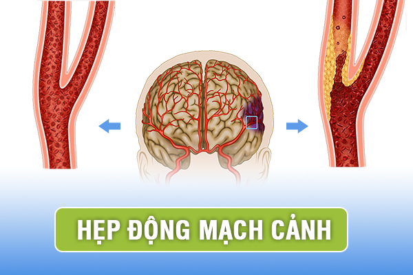 Những biến chứng nguy hiểm do hẹp động mạch cảnh và cách điều trị mới nhất 2023