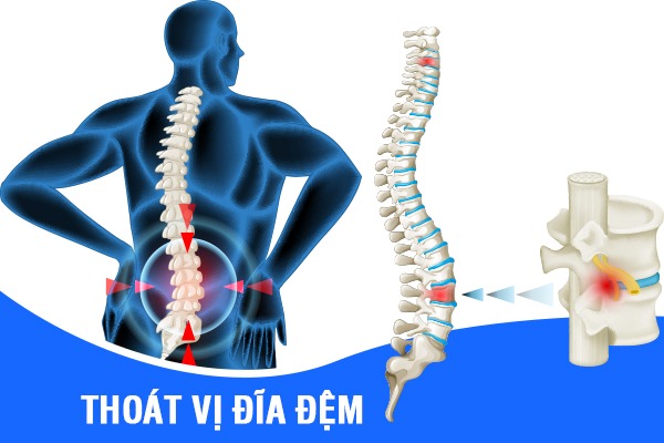 Thoát vị đĩa đệm là gì? Các phương pháp điều trị mới nhất 2023