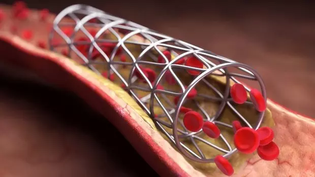 Đặt stent