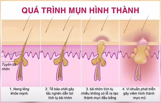 Quá trình nhân mụn hình thành