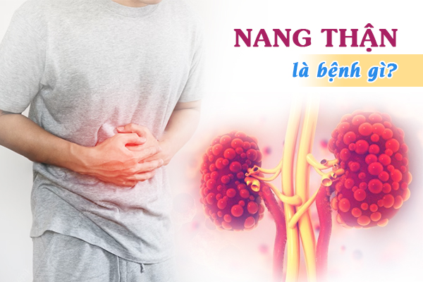 Nang thận là bệnh gì? Dấu hiệu nhận biết và cách điều trị