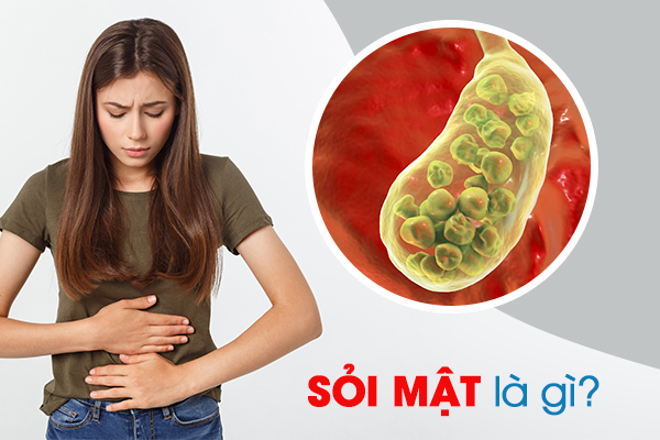 Sỏi mật: Nguyên nhân, triệu chứng và cách điều trị