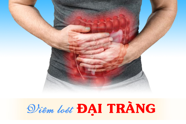 Thấy phân bất thường, cẩn trọng dấu hiệu của viêm loét đại tràng