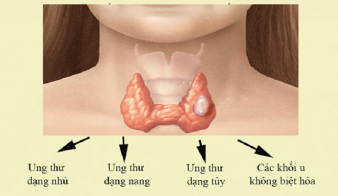 Các dạng của u tuyến giáp ác tính