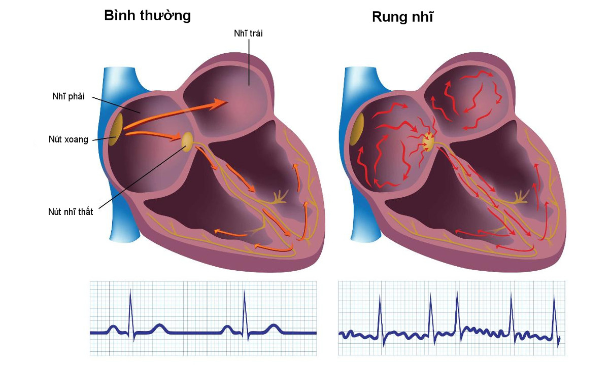 Rung nhĩ xảy ra khi hoạt động của các nút xoang bị thay đổi