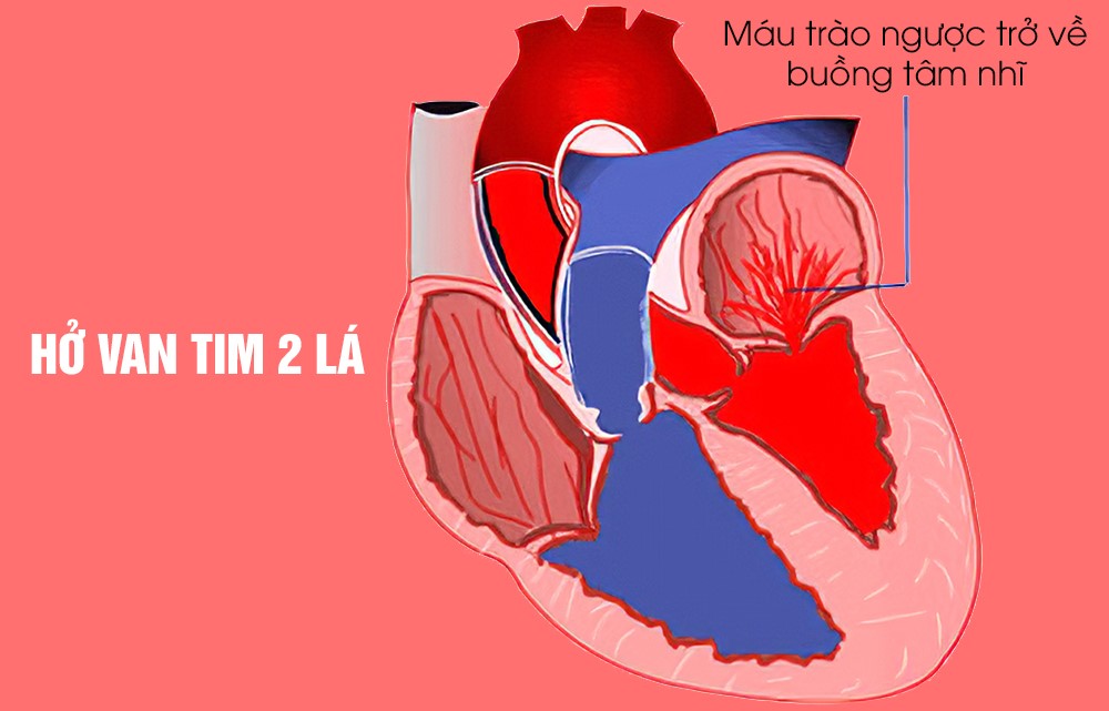  Hở van 2 lá khiến máu trào ngược về tâm nhĩ