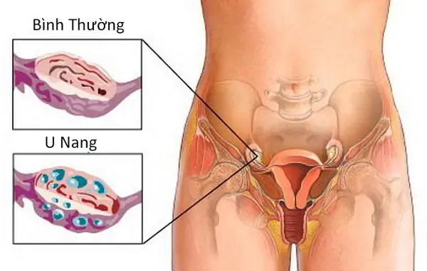 Siêu âm đầu dò giúp bác sĩ đánh giá được khối u ở bệnh nhân u nang buồng trứng.