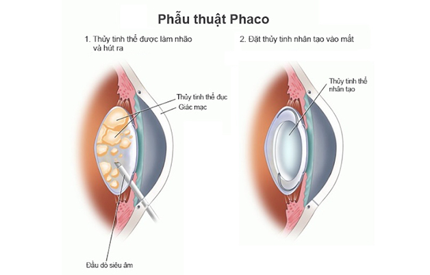 Thủy tinh thể bị đục sẽ được thay thế bằng thủy tinh thể nhân tạo.