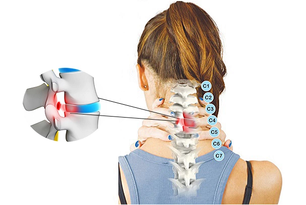  Thoái hóa đốt sống cổ có thể dẫn tới thoát vị đĩa đệm