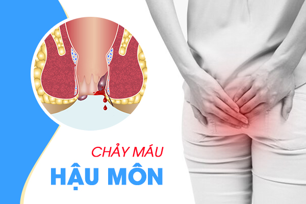 Chảy máu hậu môn là bệnh gì?