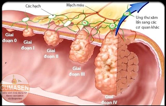 Cách nào giảm nguy cơ ung thư đại tràng?